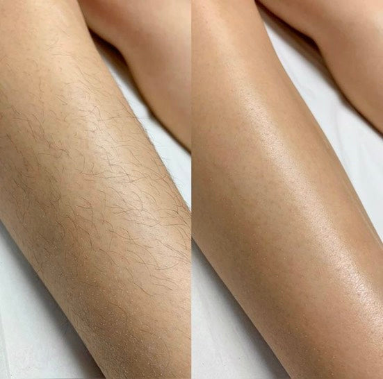 LASER HAIR REMOVAL