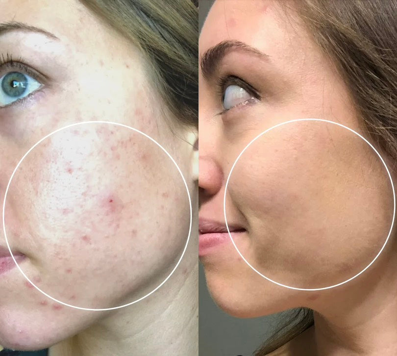 HIGH-FREQUENCY BEAUTY WAND