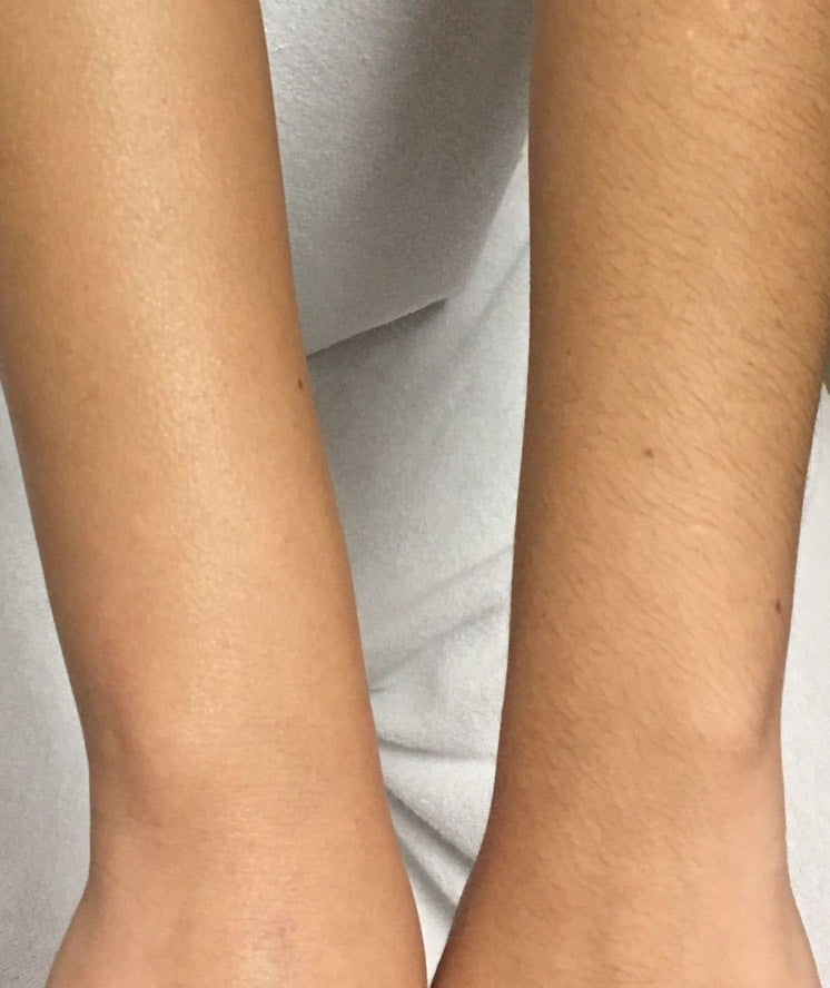 LASER HAIR REMOVAL