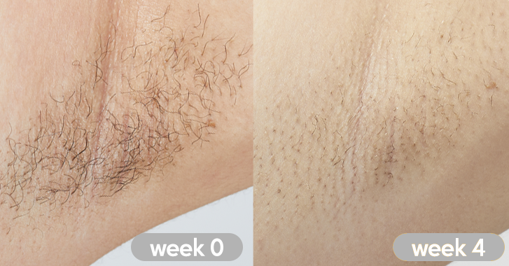 LASER HAIR REMOVAL