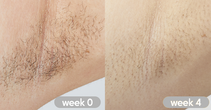 LASER HAIR REMOVAL