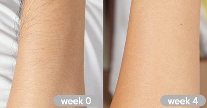 LASER HAIR REMOVAL