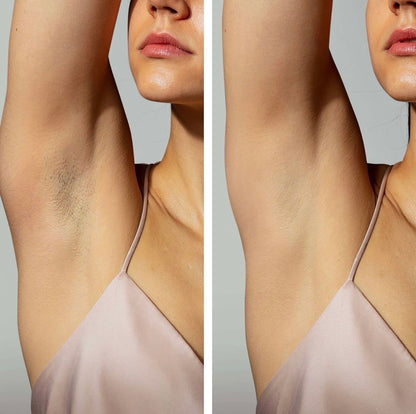 LASER HAIR REMOVAL