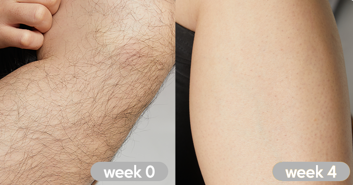 LASER HAIR REMOVAL